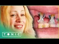 Lagu Rottende tanden hebben medische zorg nodig | De slechtste tanden van Groot-Brittannië | Tonic