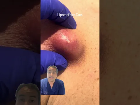 Dr Khaled explains #cystremoval #drkhaledsadek