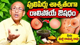 పులిపిర్లు శాశ్వతంగా రాలిపోయే ఔషధం మీరు || ManamTv