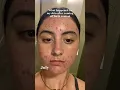 What happened to my skin after coming off of birth control