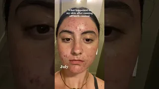 What happened to my skin after coming off of birth control
