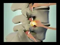 Lumbar disc herniation