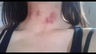هل تعلم سبب ظهور البقع الحمراء ما بعد الجماع دندنها