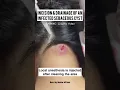 Download Lagu Incision and Drainage of a Sebaceous vs Epidermoid Cyst #shorts