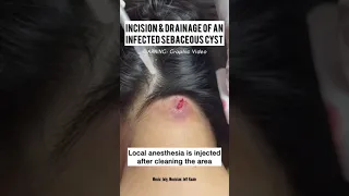 Incision And Drainage Of A Sebaceous Vs Epidermoid Cyst Shorts 