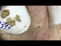 Loan Nguyen Acne Treatment 313pre