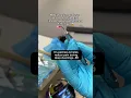 Laser Treatment at Jefferson Dental