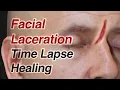 Facial Laceration Time Lapse Healing via Secondary Intention