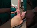 Removing a Junction Adhesion in the to Fix Chronic Shoulder Pain