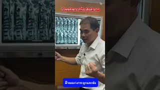  ทำไมการปวดหลังและชาที่แขนขา รวมถึงเดินลำบาก จึงอาจเกิดจากหมอนรองกระดูกในคอ 