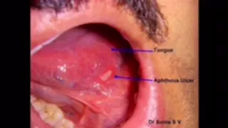 جرح السان قرحة اللسان 