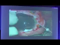 Download Lagu AIOC 2023 FP1666  Trauma topic Dr  MANISHA AGARWAL Managing Large Cyclodialysis cleft