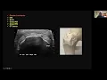 Lateral Hip with Dr Douglas Hoffman AMSSM Sports Ultrasound Case Presentation