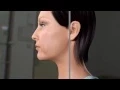 Capital Skin Double Chin Chin Lift Clifton Park Saratoga Albany Latham Schenectady
