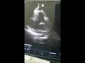 Early Repolarization in Young Patient - By Prof Saleh Al-Awdhaly