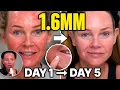 I Microneedled My Face at 1 6MM Watch the Healing Day by Day Dr Pen M9 Dermaheal HSR