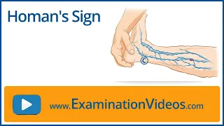Homan s Sign