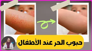    طرق أكيدة لعلاج حمو النيل أو حبوب الحر  فى المنزل وبدون أدوية     جلدية دندنها