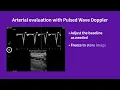 Vscan Air Using preset for arterial evaluation