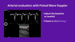 Vscan Air Using preset for arterial evaluation