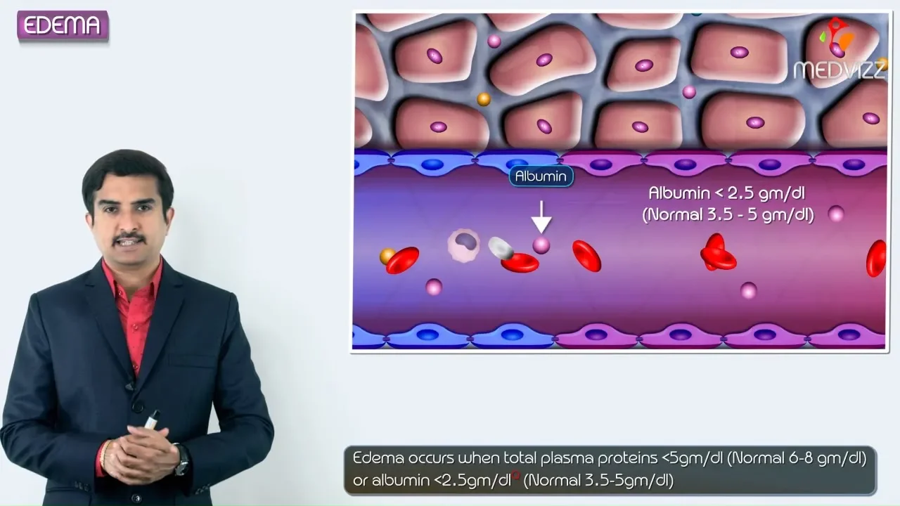 1.Edema introduction - Hemodynamic pathology Fmge, Neet PG and  usmle