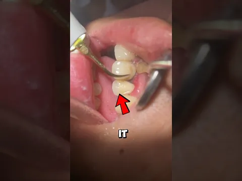 Why Dentists Have to Remove Tartar