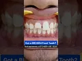Download Lagu Got a BROKEN Front tooth? Repair it today! Dr. Srishti Bhatia #smilemakeover