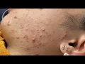 Blackhead Whitehead Extractions P 1