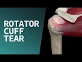 Lagu Rotator Cuff Tear