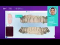 How to scan for a surgical guide with an iTero Element scanner