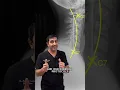 Did you know this about spinal stenosis