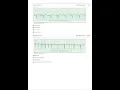 Relias Dysrhythmia Basic Test Answers 2025 Dysrhythmia - Basic A A GRADED 100 VERIFIED