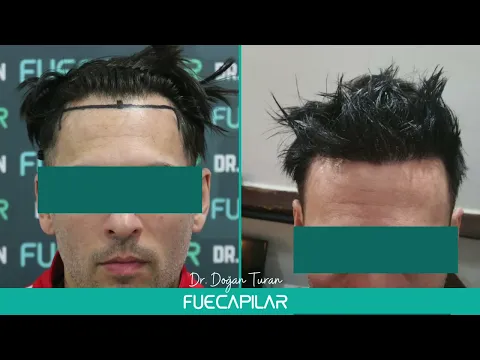 Download MP3 DHI Hair Transplant (2338 Grafts NW III) by Dr Turan - FUECAPILAR, Istanbul, Turkey