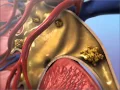Download Lagu Kidney Stones: Learn@Visible Body