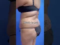 360 Liposuction Dr Erez Dayan Avance Plastic Surgery