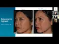 Reduce The Signs Of Aging With Minimal Downtime With LaseMD Ultra Scherl Dermatology Webinar