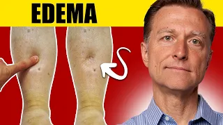 Download 8 Surprising Causes of Edema: Uncover the Truth! MP3