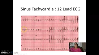 Sinus Tachycardia