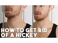 HOW TO Get Rid of a Hickey in Two Minutes