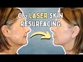 CO2 Laser Skin Resurfacing Treatment Real OR Footage Before After Results