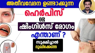 അതീവവേദന ഉണ്ടാക്കുന്ന ഹെർപിസ് or ഷിംഗിൾസ് രോഗം എന്താണ് ? ചികിത്സ എന്ത് ?