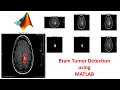 Brain Tumor Detection using MATLAB Image processing