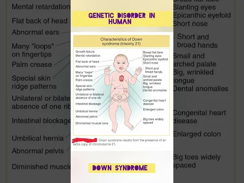 Download MP3 Down Syndrome | Trisomy 21 | Genetic Disorder in Human