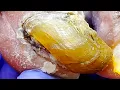 Download Lagu Onychomycosis Is Harder Than Stone  Cut Off The Bad Nails Piece By Piece【Xue Yidao】