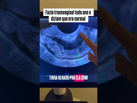 Endometriose profunda intestinal #ultrasound #endometriose