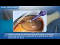 Cataract surgery Phacoemulsification English