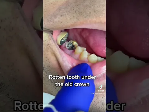 ROTTEN TOOTH UNDER THE CROWN 🥴🦷