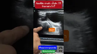  ถุงน้ำที่ข้อมือเกิดจากอะไร และมีลักษณะอย่างไร 