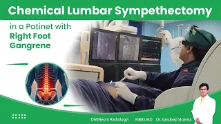 Chemical Lumbarsympathectomy in a patient with Right Foot Gangrene.
