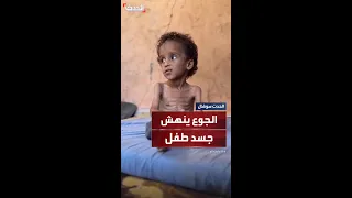 طفل أنهكت جسده حرب التجويع في قطاع غزة إلى جانب حرب القصف والرصاص والتشريد  طفل أنهكت جسده حرب التجويع في قطاع غزة إلى جانب حرب القصف والرصاص والتشريد